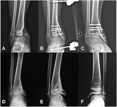 Case report: Reconstruction of distal medial tibial epiphysis using iliac crest apophyseal autograft